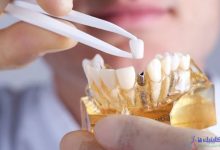 متخصص ایمپلنت دندانی چه کاری باید انجام دهد
