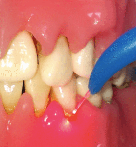 دندانپزشکی با لیزر برای رفع عفونت لثه