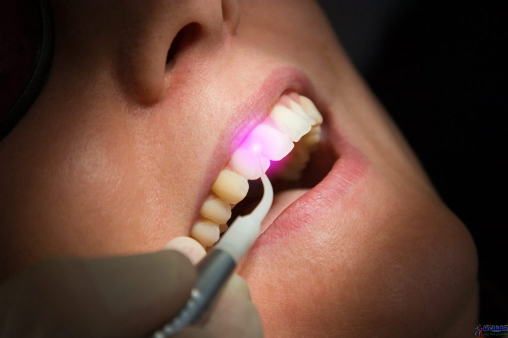 لیزردرمانی لثه دندانپزشکی