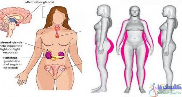 کاهش چربی دور کمر و باسن و شکم با طب سوزنی لیزری 