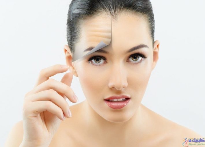 رفع چین و چروک با طب سوزنی زیبایی