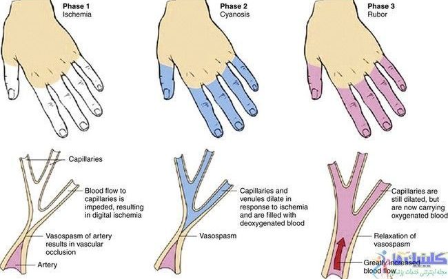 طب سوزنی برای درمان گردش نامناسب خون دست و پا یا پدیده رینود