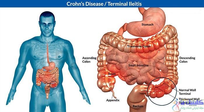 درمان بیماری کرون و رفع علائم آن با طب سوزنی و گیاهان دارویی چینی