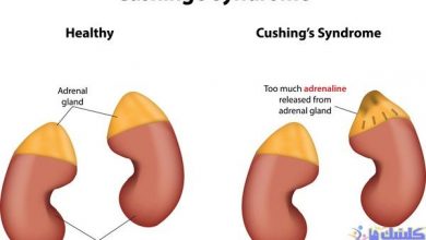 استفاده از طب سوزنی برای درمان سندرم کوشینگ و رفع علائم و عوارض این بیماری