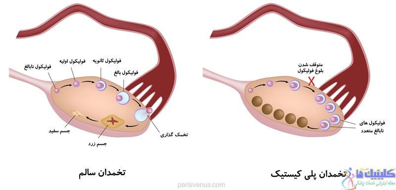 تخمدان پلی‌کیستیک