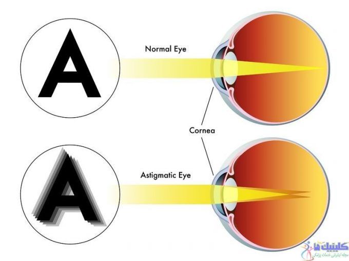 یکی از علائم بیماری آستیگماتیسم چشم