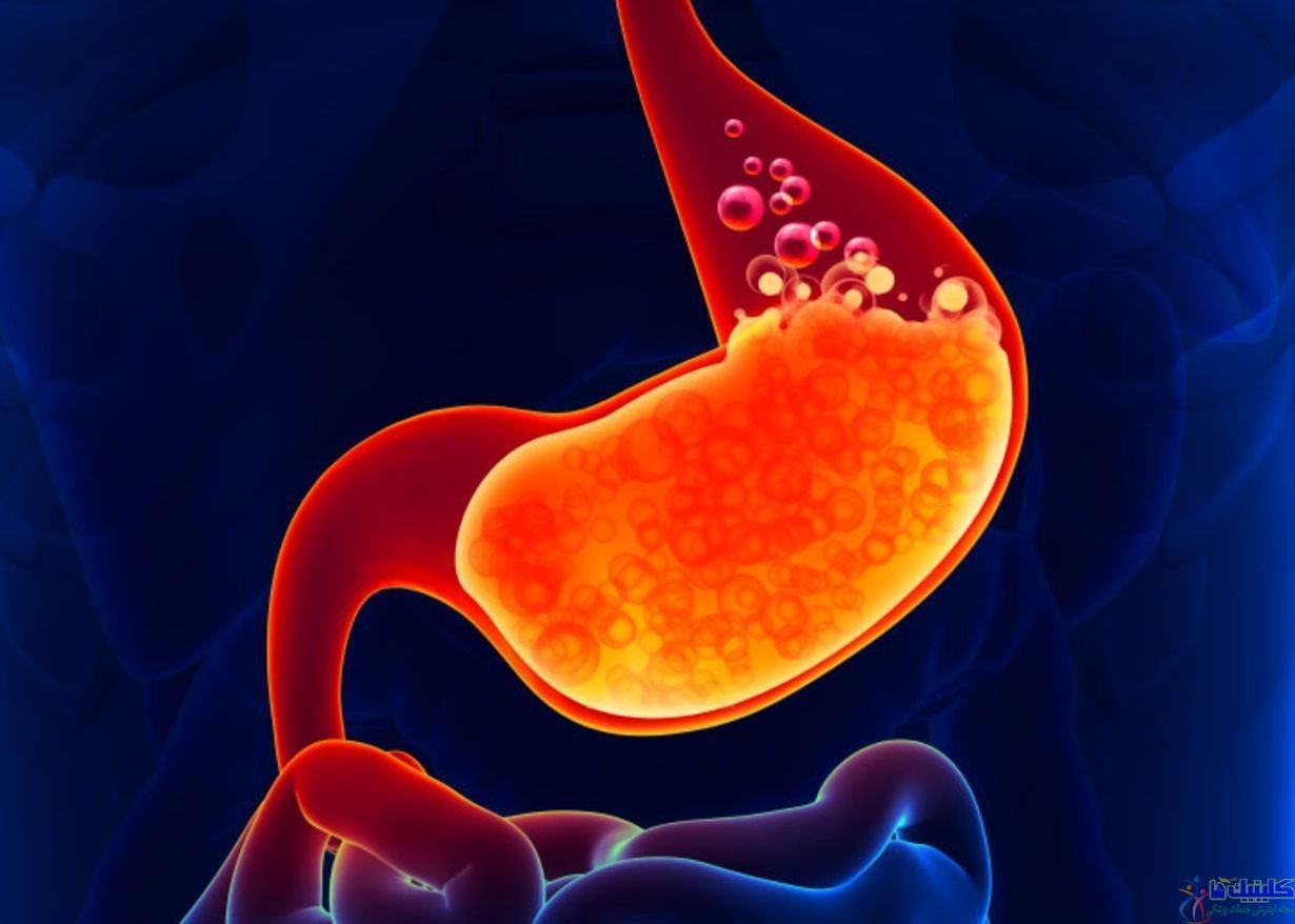 بیماری رفلاکس معده و مری با چاره های طبیعی برطرف می شود