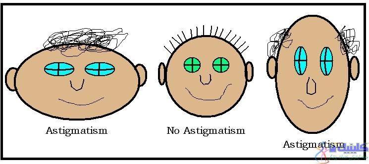 جلوگیری از بیماری آستیگماتیسم