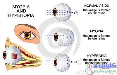 نزدیک بینی یا دوربینی چشم
