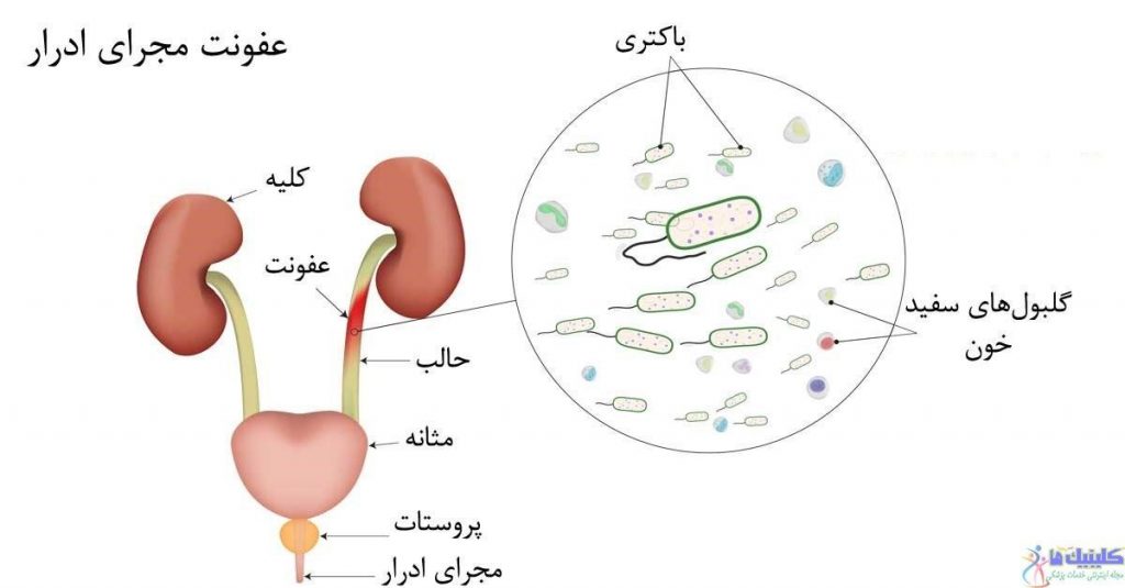 پیشگیری و تشخیص درست بیماری مثانه پر کار