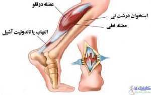 درمان درد پاشنه پا یا آشیل پاشنه