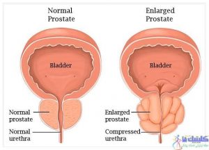 بزرگ شدن پروستات یا پروستات ملتهب چطور اتفاق می افتد؟