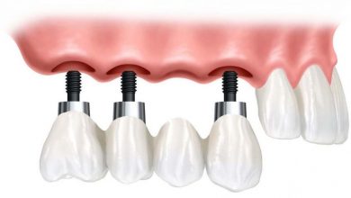 بریج دندان مصنوعی با ایمپلنت به جای دندان از دست رفته در صدمات ورزشی و غیره