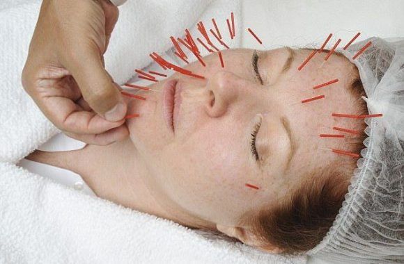 طب سوزنی برای زیبایی پوست-طب سوزنی برای چاق شدن صورت