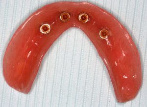 دندان مصنوعی کامل با روش 4 ایمپلنت