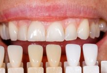 ونیر کامپوزیت دندان در مقابل ونیر دندان چینی، چه تفاوتی دارند؟