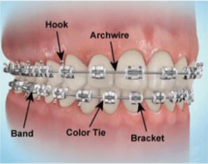 انواع بریس ها یا ارتودنسی