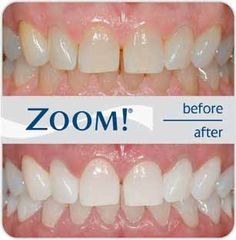 بلیچینگ دندان خیره کننده Zoom Whitening در یک ساعت