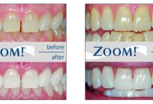 روش سفید کردن دندان در مطب خیره کننده Zoom Whitening در یک ساعت