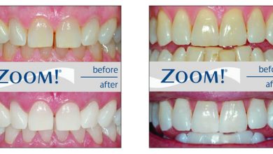 روش سفید کردن دندان در مطب خیره کننده Zoom Whitening در یک ساعت