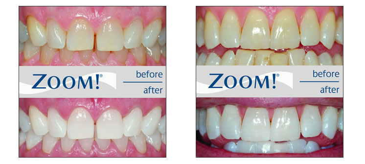 روش دندانپزشکی بلیچینگ دندان خیره کننده Zoom Whitening در یک ساعت