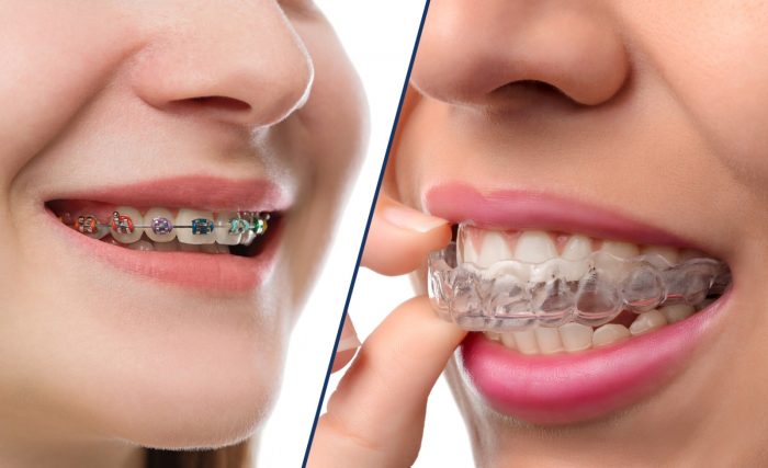 آیا ارتودنسی نامرئی Invisalign به خوبی سایر ارتودنسی براکت کار می کند؟