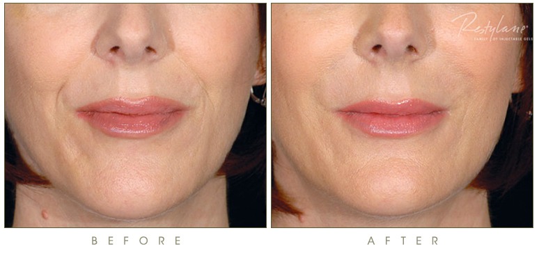 تمام آن چه باید درباره تزریق فیلر رستیلن Restylane بدانید