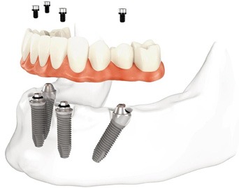 اتصال دندان مصنوعی با all on 4