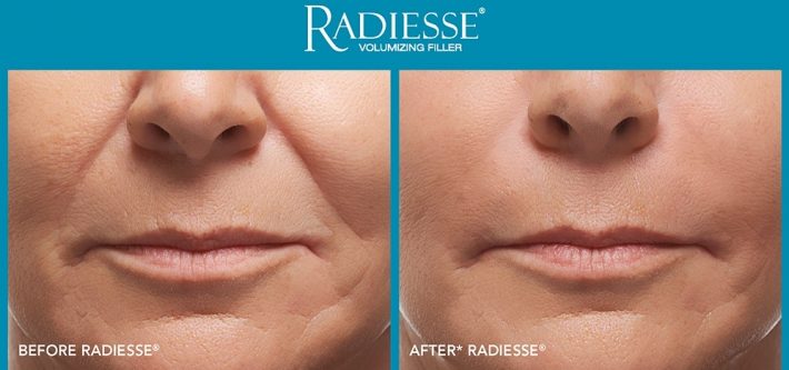 تزریق ژل خط خنده رادیس Radiesse چروک های عمیق را سریعتر برطرف می کند