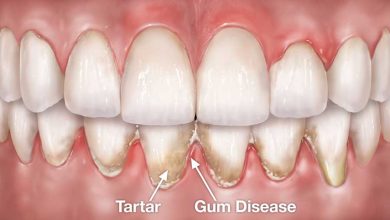 جراحی لثه پریودُنتال برای رفع عفونت و التهاب و بیماری لثه ها