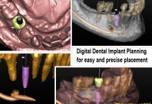 ایمپلنت های دندان دیجیتال راحت تر از روش کاشت دندان قبلی هستند