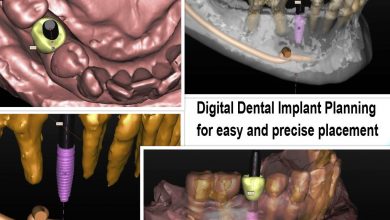 ایمپلنت های دندان دیجیتال راحت تر از روش کاشت دندان قبلی هستند