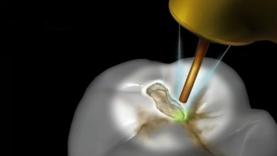 لیزر دندانپزشکی بافت سخت، بهبود درمان ترمیمی و رفع پوسیدگی دندان ها و پر کردن دندان با لیزر