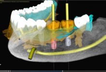 چگونه ایمپلنت دندان دیجیتال امکان سریع و با کیفیت تر را فراهم کرده است