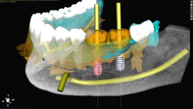چگونه ایمپلنت دندان دیجیتال امکان سریع و با کیفیت تر را فراهم کرده است