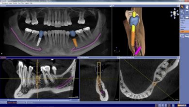 تکنولوژی تصویربرداری دو و سه بعدی برای ایمپلنت دندان دیجیتال