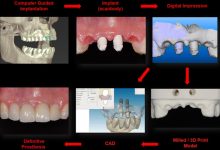 مراحل انجام ایمپلنت دندان دیجیتال در یک مکان