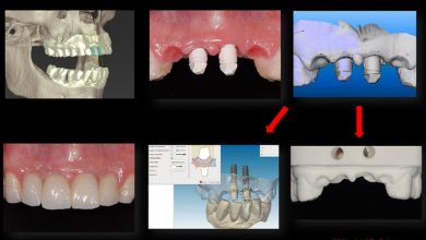 مراحل انجام ایمپلنت دندان دیجیتال در یک مکان
