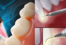 دندانپزشکی لیزری بافت نرم و سخت برای بهبود درمان های لثه و دندان