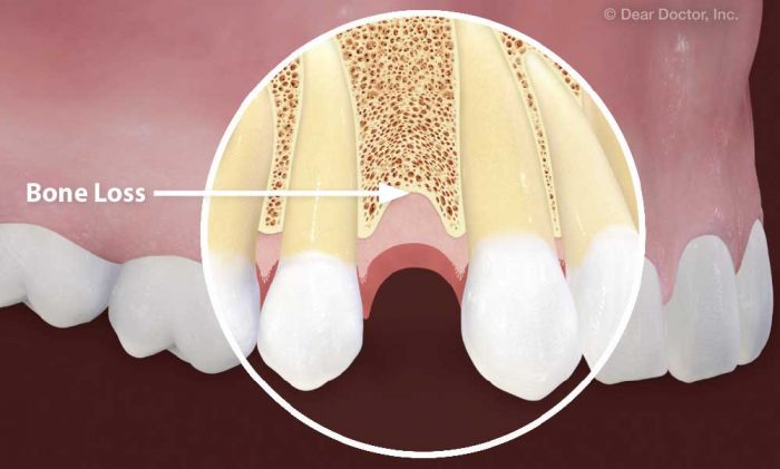 نحوه پیشگیری برای تحلیل رفتن استخوان فک