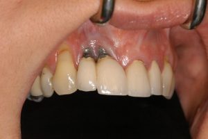 یک نمونه از علائم پس زدن ایمپلنت دندان