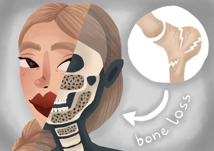 استخوان کافی برای ایمپلنت دندان وجود ندارد؟ درمانی صحیح برای زیبایی لبخند شما