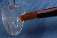 ساده سازی قرار دادن ونیر کامپوزیت دندان به طور مستقیم با یو ونیرها