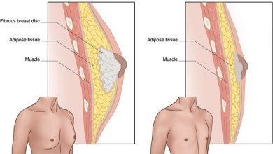 کوچک کردن سینه مردان با جراحی ژنیکوماستی: آنچه باید بدانید!؟