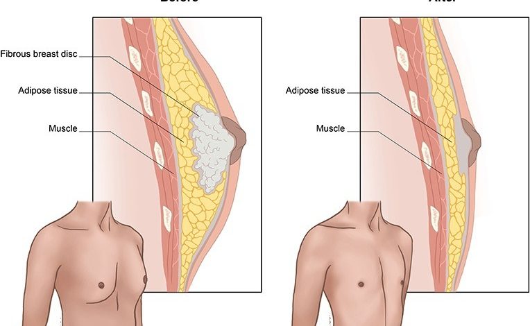 کوچک کردن سینه مردان با جراحی ژنیکوماستی: آنچه باید بدانید!؟