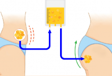 تزریق چربی به باسن برزیلی برای حجم دهی و لیفت، آنچه که باید بدانید!؟