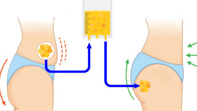 تزریق چربی به باسن برزیلی برای حجم دهی و لیفت، آنچه که باید بدانید!؟