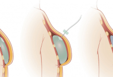 بزرگ کردن سینه با پروتز سینه یا ایمپلنت آنچه که باید بدانید!؟