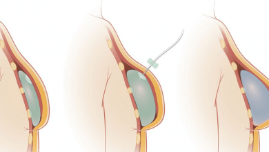 بزرگ کردن سینه با پروتز سینه یا ایمپلنت آنچه که باید بدانید!؟