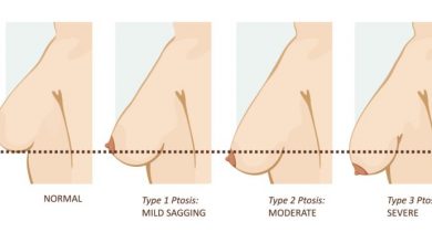 عمل لیفت سینه با پروتز یا ایمپلنت چیست، آنچه که باید بدانید!؟